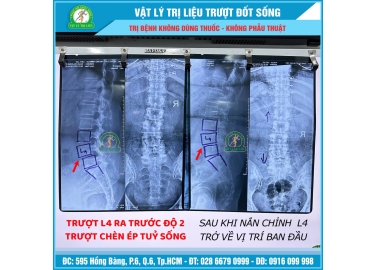 Vật Lý Trị Liệu Trượt Đốt Sống – Giải Pháp Phục Hồi An Toàn, Không Dùng Thuốc